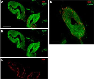 Case report: De novo mutation of a-galactosidase A in a female patient with end-stage renal disease: report of a case of late diagnosis of Anderson–Fabry disease